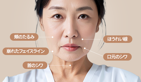 チャミンSMASフェイスリフト術