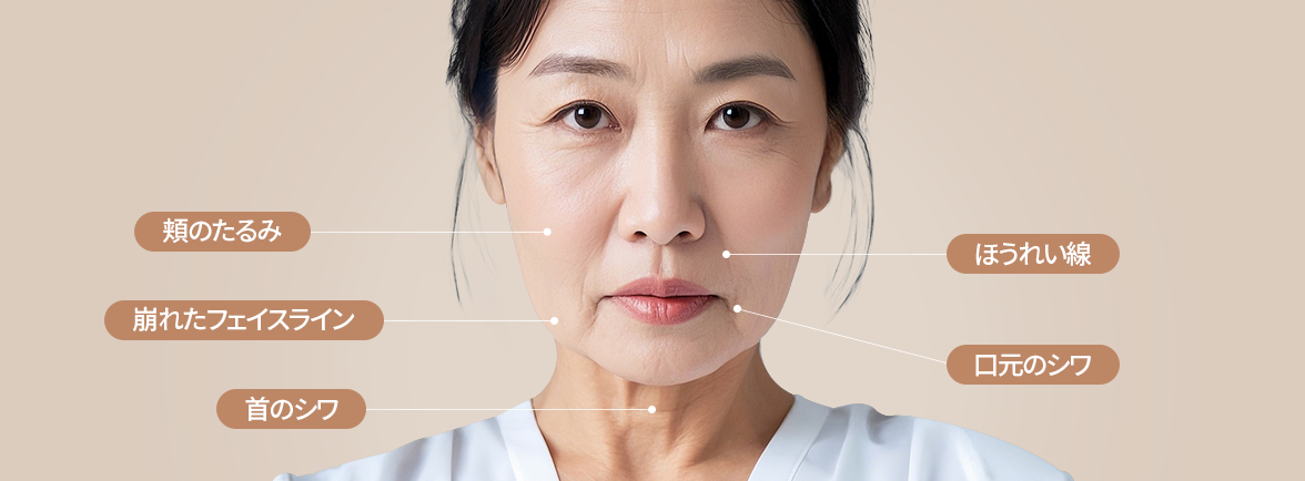 チャミンSMASフェイスリフト術